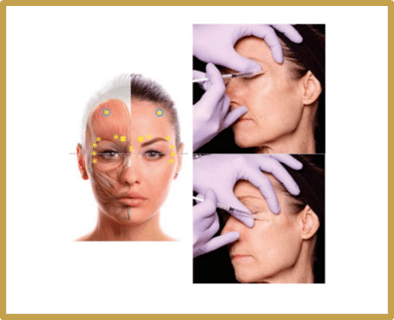 Two Sides of the Same Coin - Botulinum Toxin as Both Neurotoxin and Beauty Enhancer